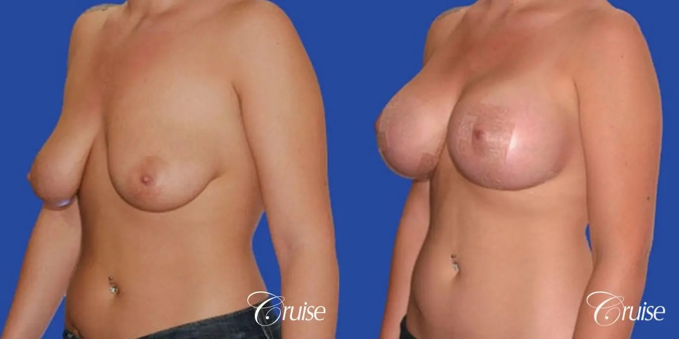 best photos of 20 yr old with saline breast reduction surgery - Before and After 3