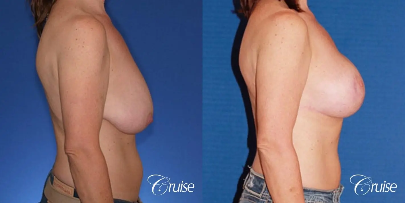 best breast reduction surgery with saline implants - Before and After 3