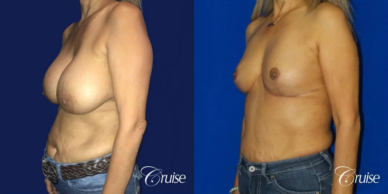 Best Breast reduction results and recovery - Before and After 3