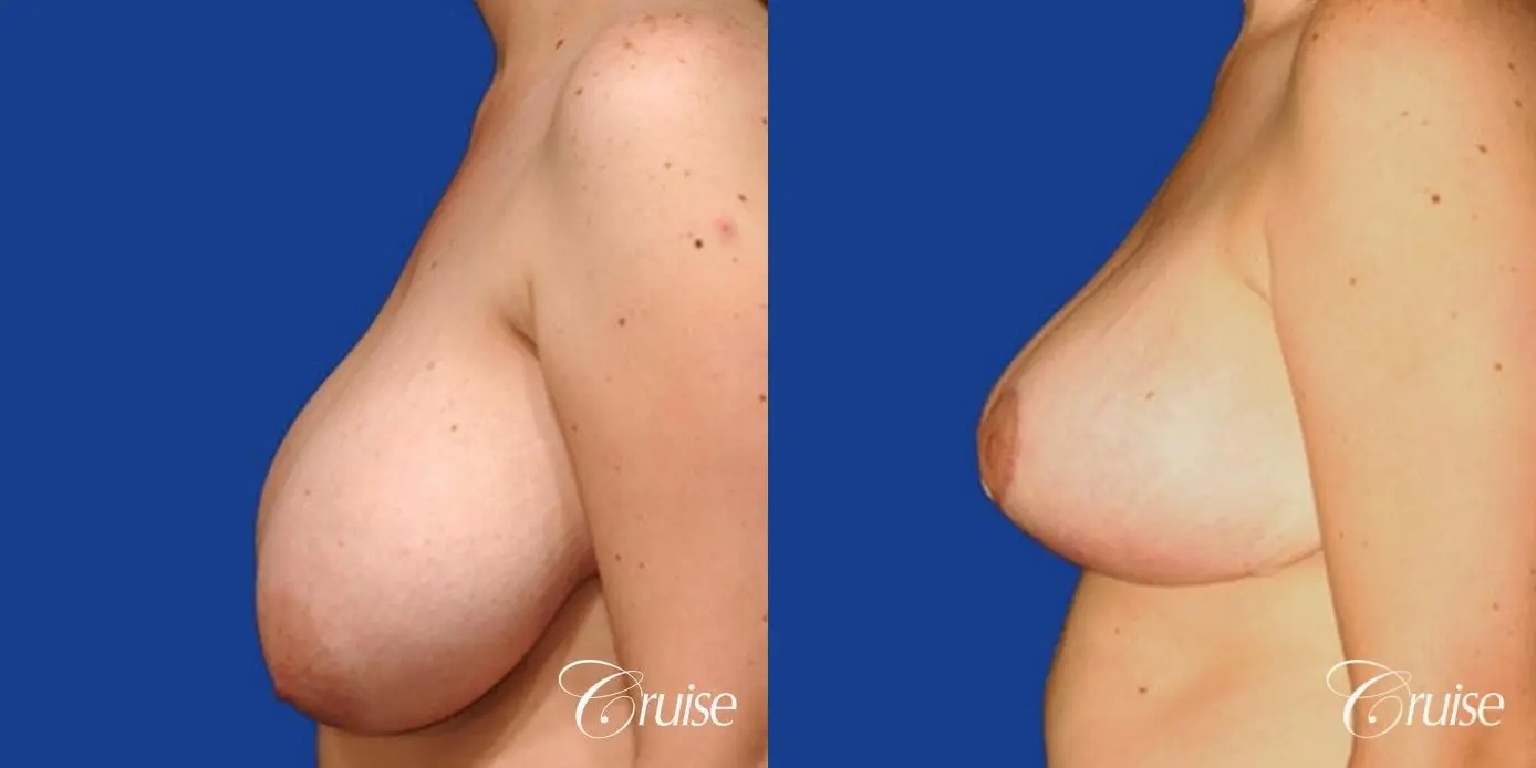 breast reduction with silicone gel implants - Before and After 2
