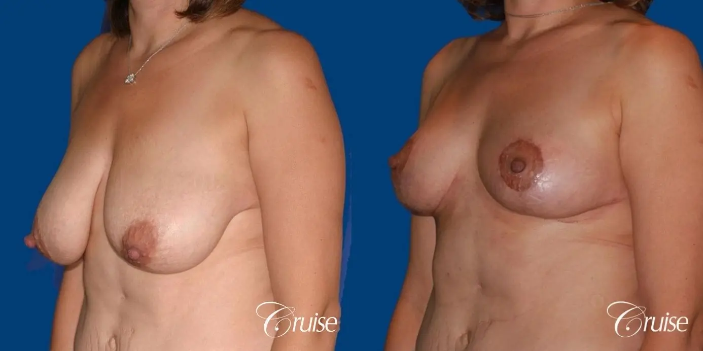 best breast reduction no implants - Before and After 3