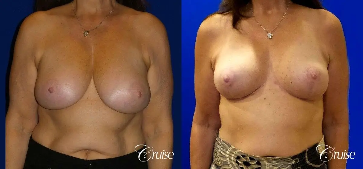 Breast Reduction - No Implants - Before and After 1