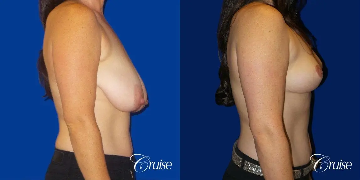 Breast Reduction No Implants - Before and After 3