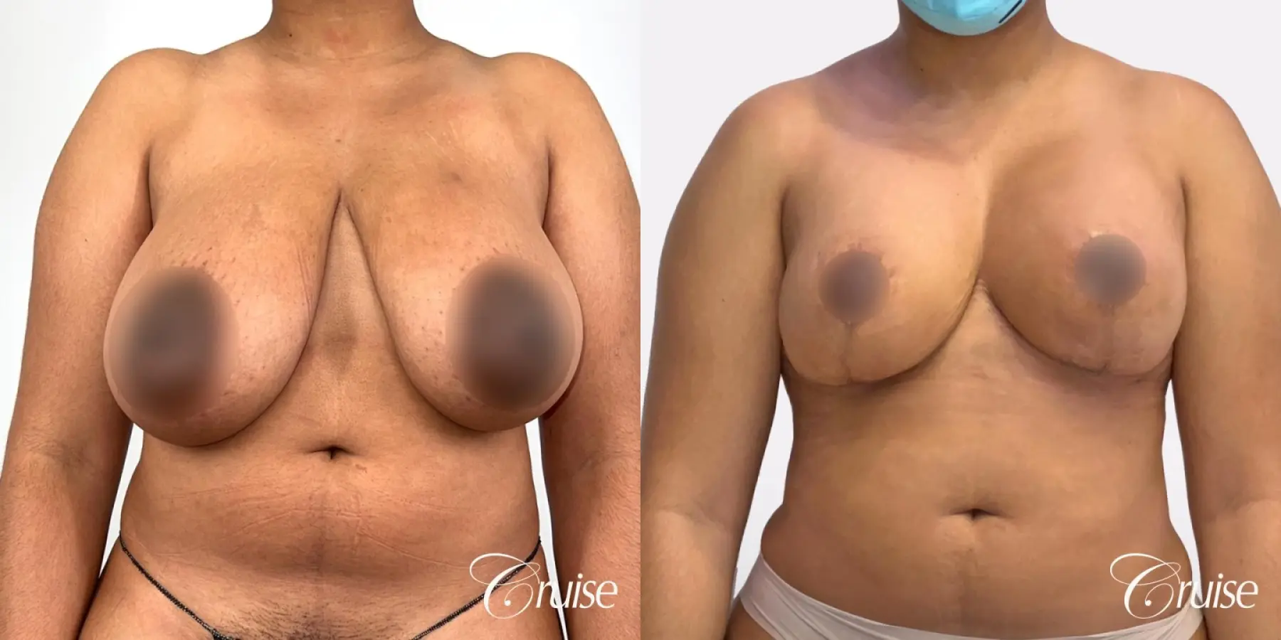 Breast Reduction & Breast Lift - Before and After 1