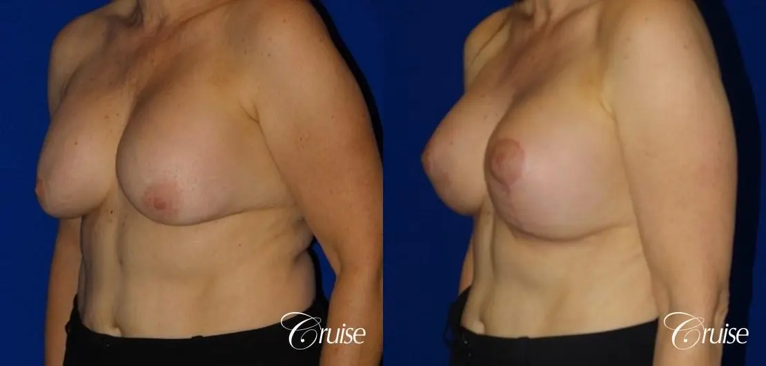Breast Reduction - No Implants - Before and After 2