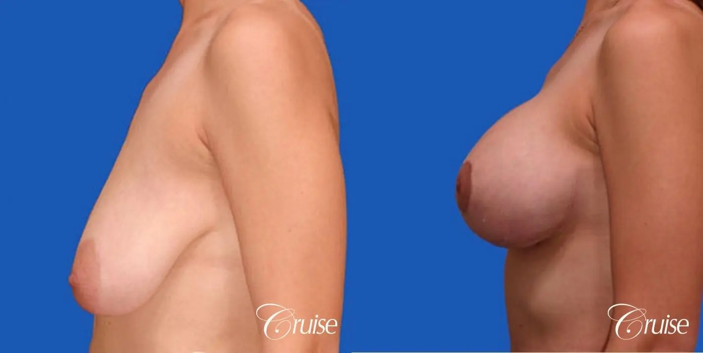best round saline breast reduction lift surgery - Before and After 2