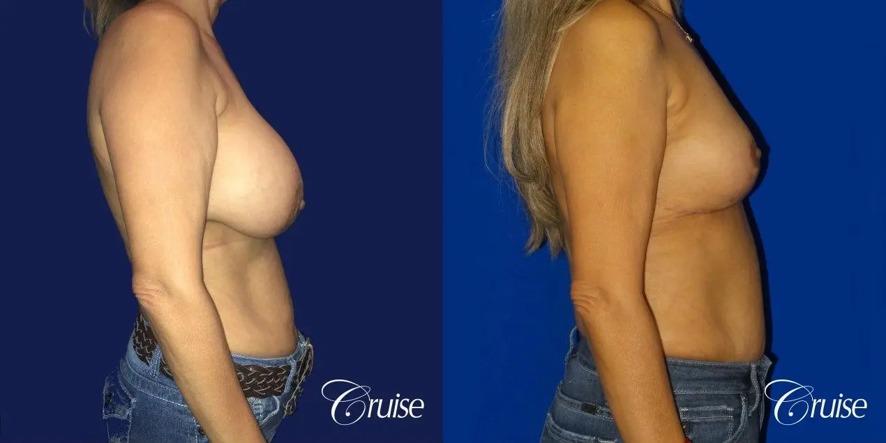 Best Breast reduction results and recovery - Before and After 4