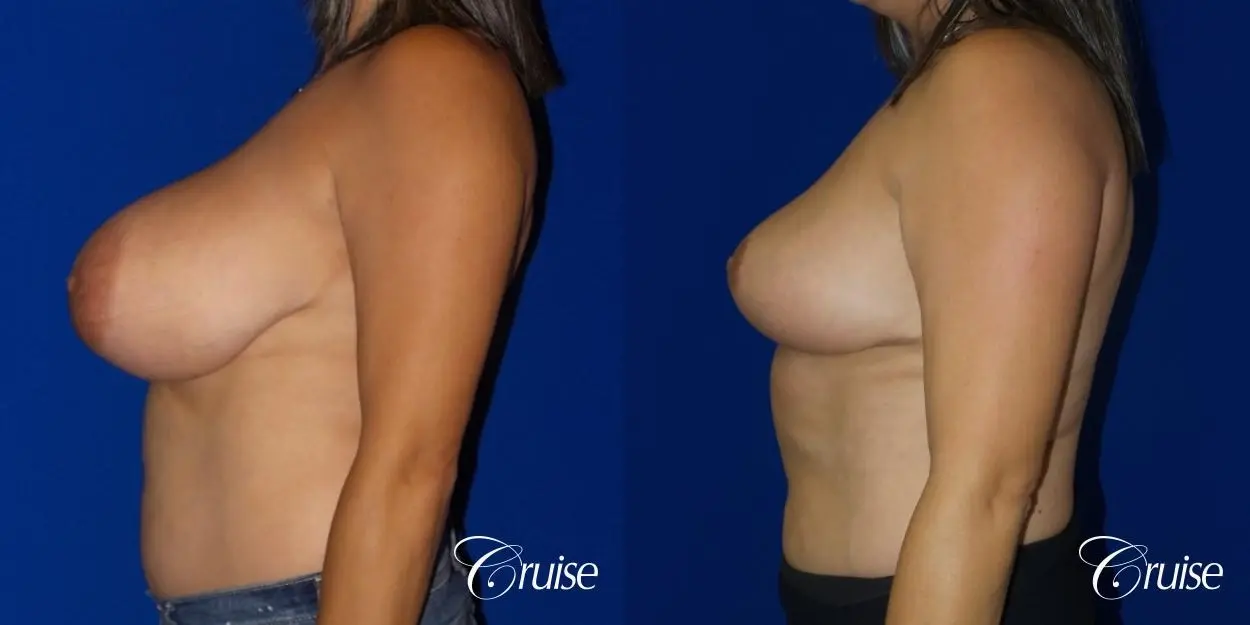 Breast reduction surgery with no implants added - Before and After 3