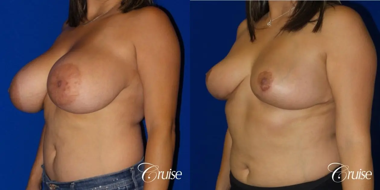 Breast reduction surgery with no implants added - Before and After 2