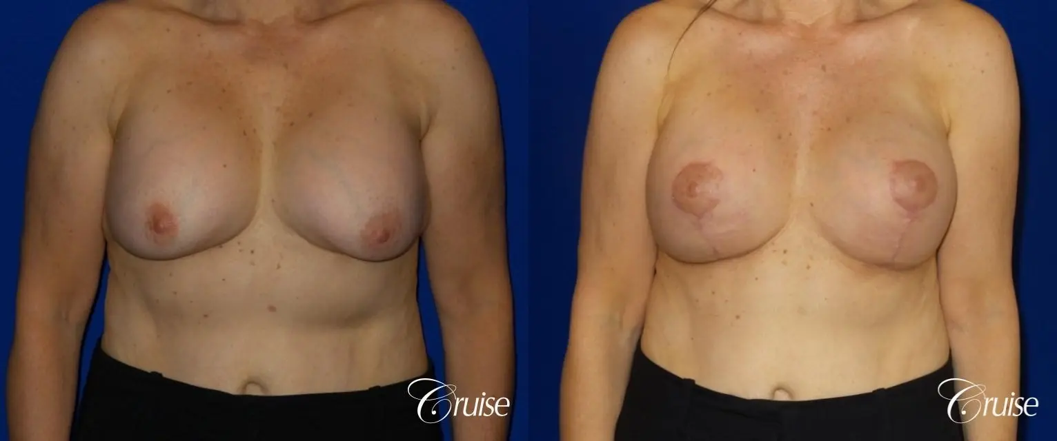 Breast Reduction - No Implants - Before and After 1