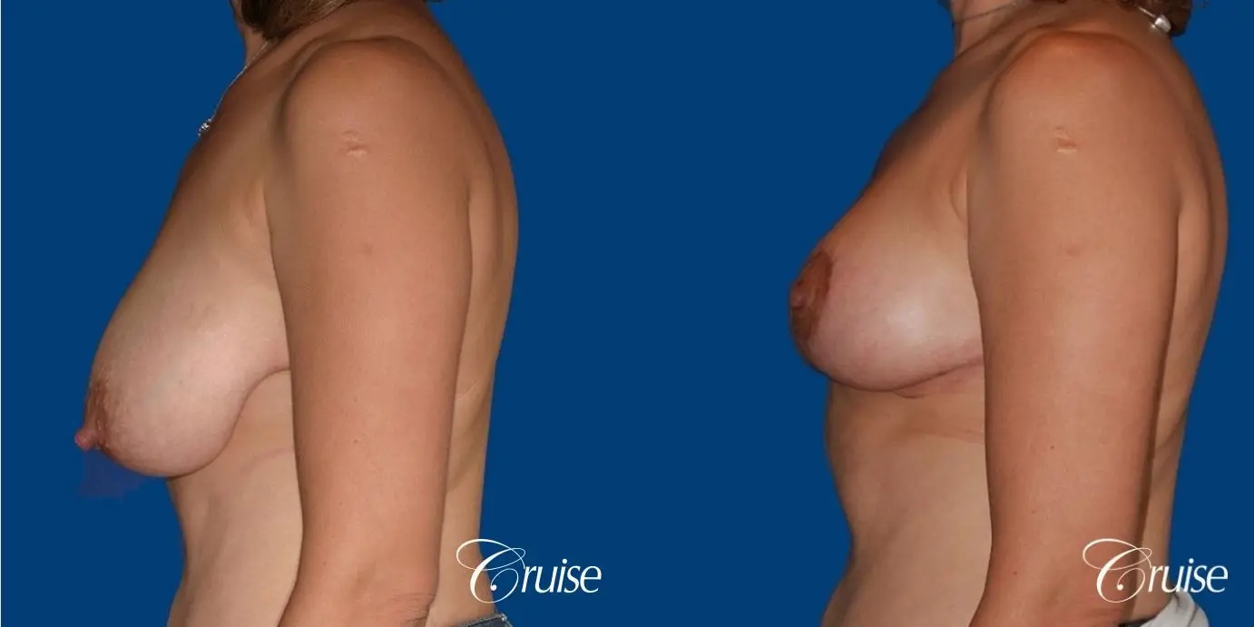 best breast reduction no implants - Before and After 2