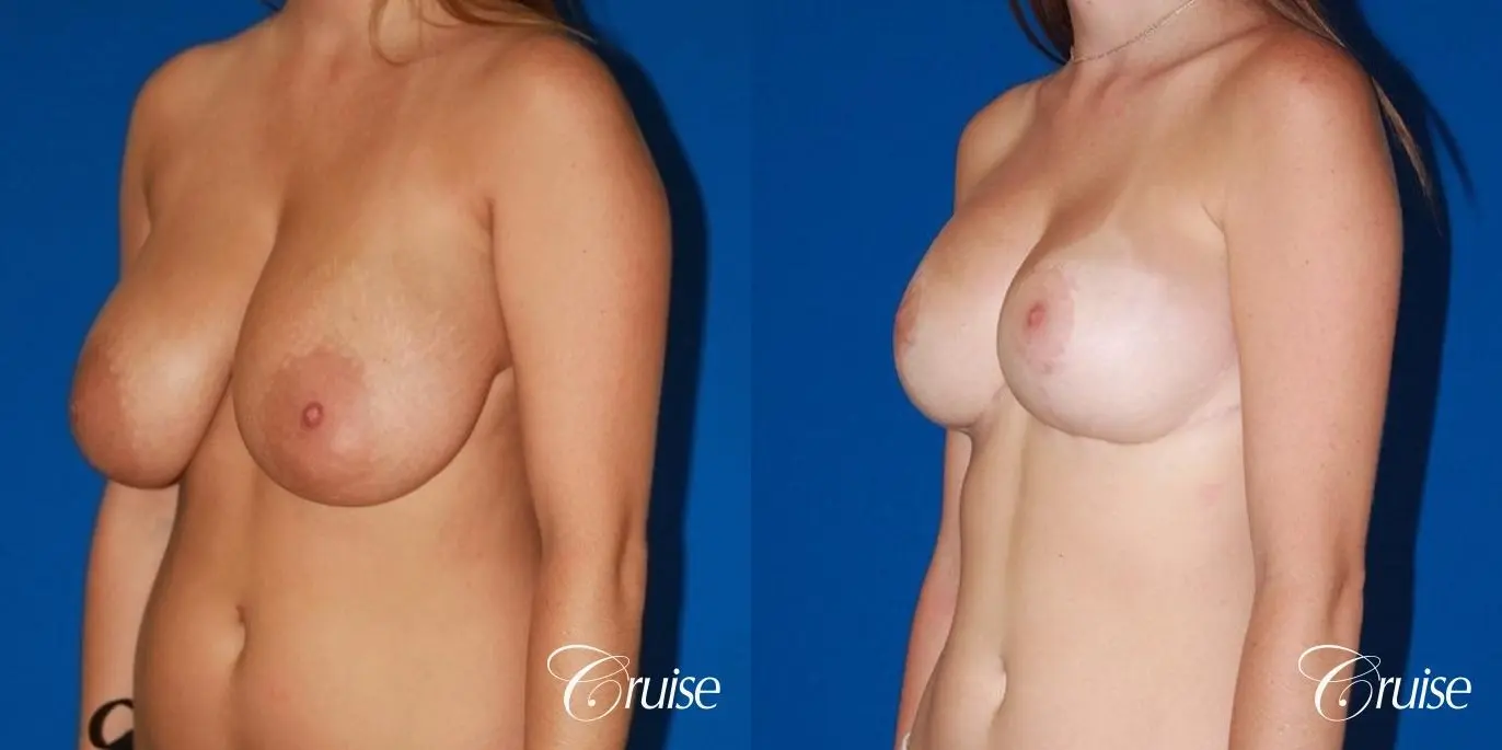best saline breast reduction on large breast - Before and After 3