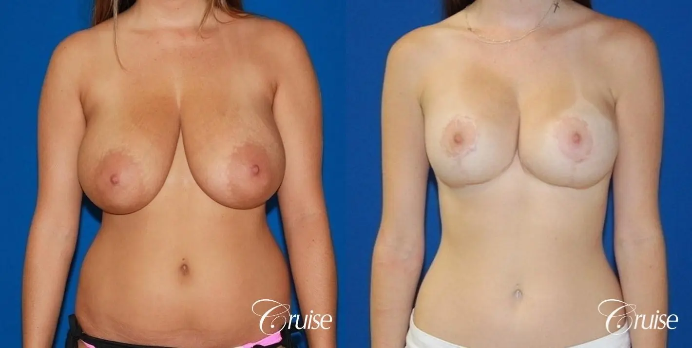 best saline breast reduction on large breast - Before and After 1