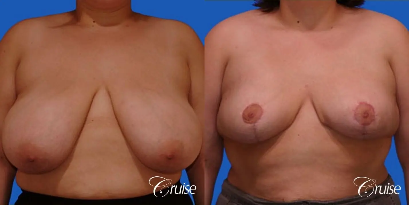 breast reduction surgery on large breast - Before and After 1