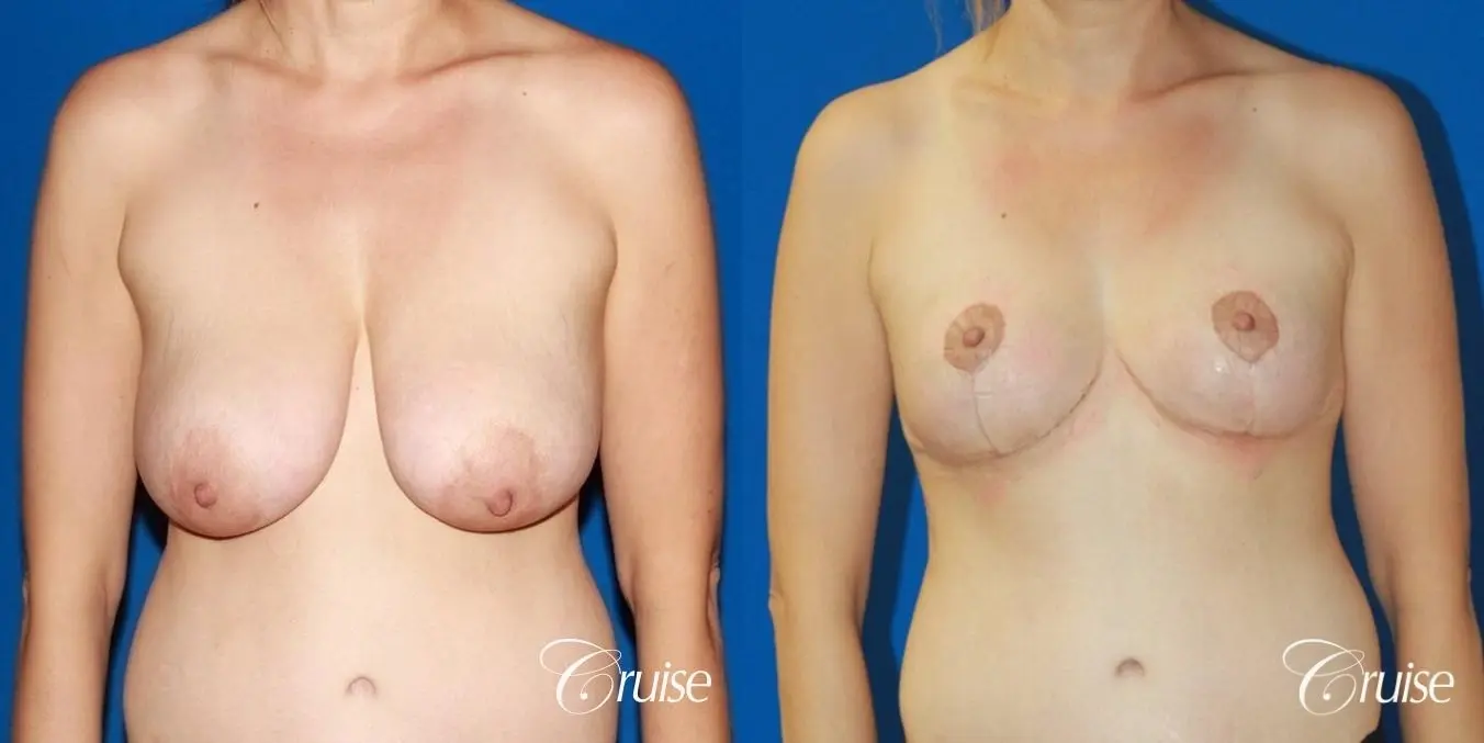 best reduction without implants in Newport Beach - Before and After 1