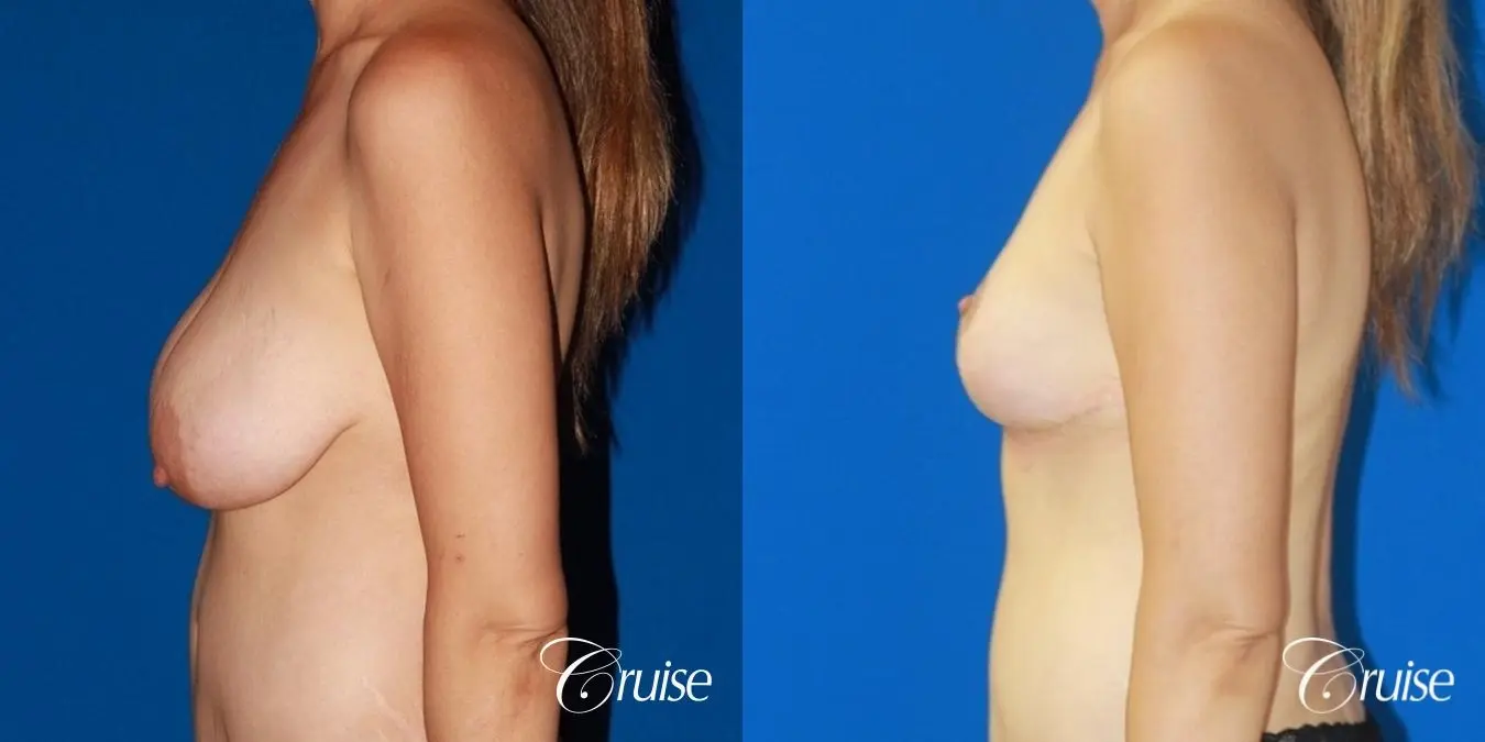 best reduction without implants in Newport Beach - Before and After 2