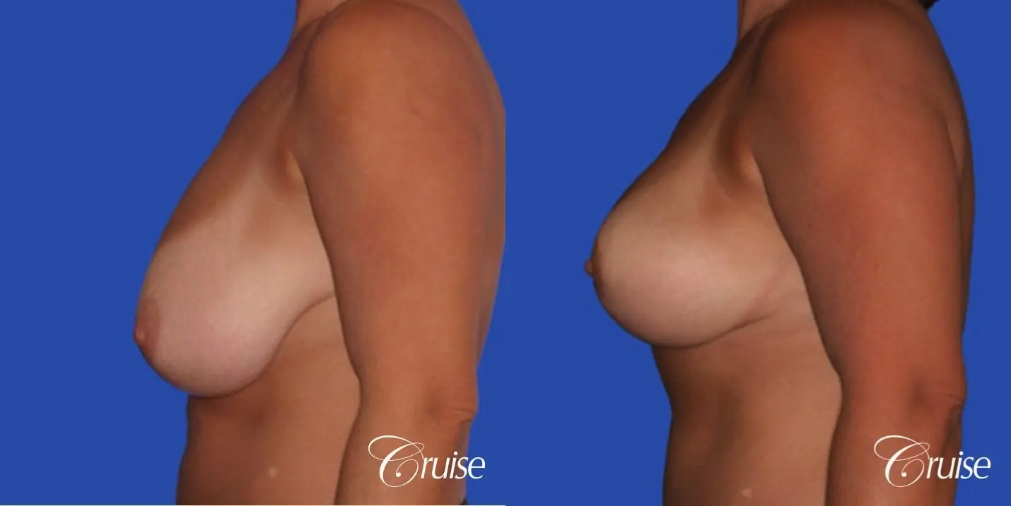 best breast lift and reduction with plastic surgeon in Newport Beach - Before and After 2