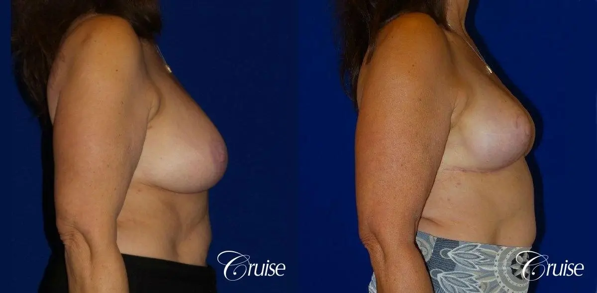 Breast Reduction - No Implants - Before and After 4
