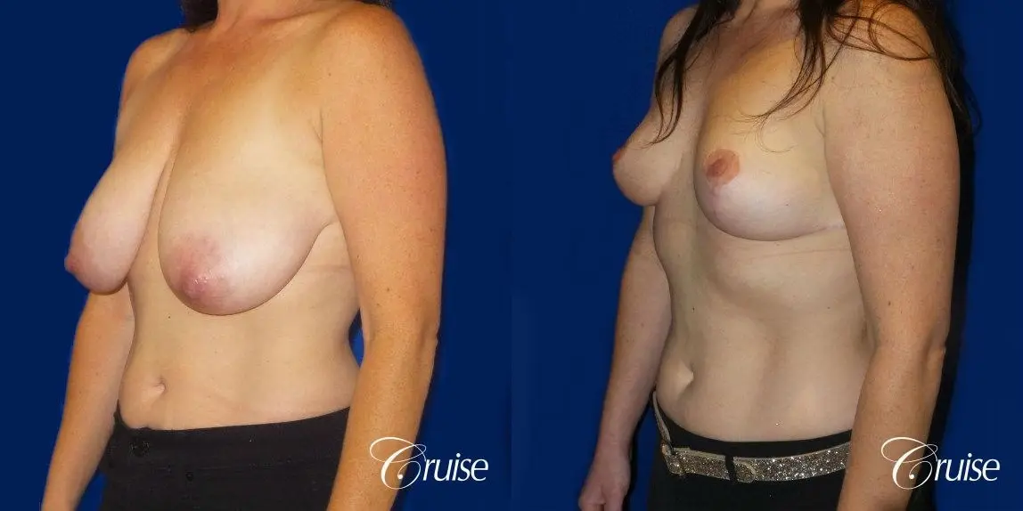 Breast Reduction No Implants - Before and After 2