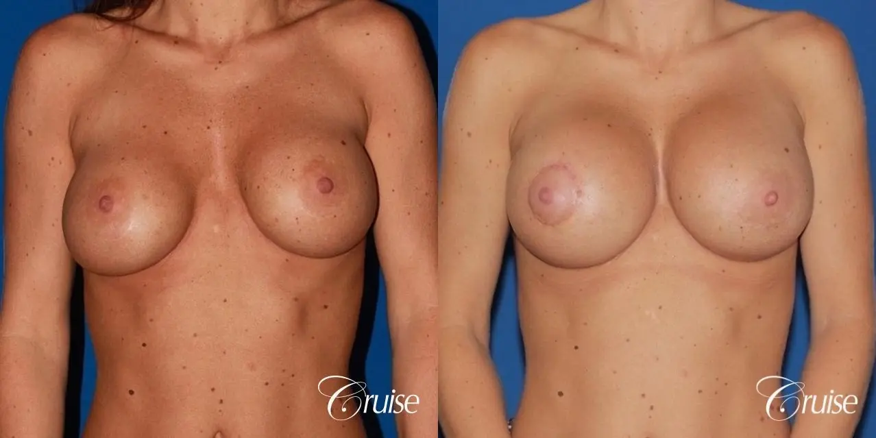 breast reconstruction better cleavage and capsulectomy - Before and After 1