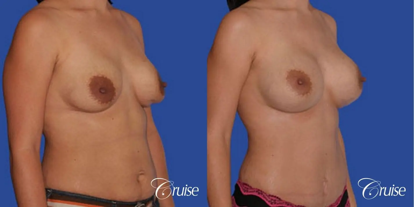 best breast revision correction of double bubble - Before and After 2
