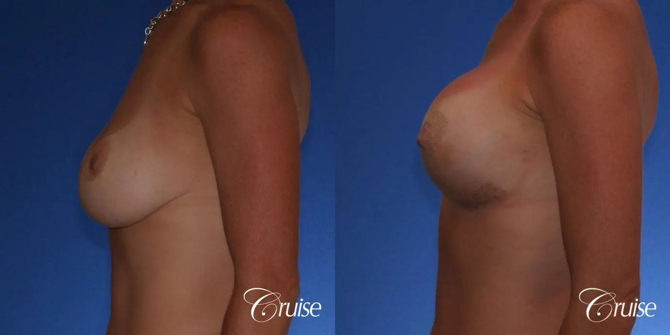 Best breast revision for low implants - Before and After 2