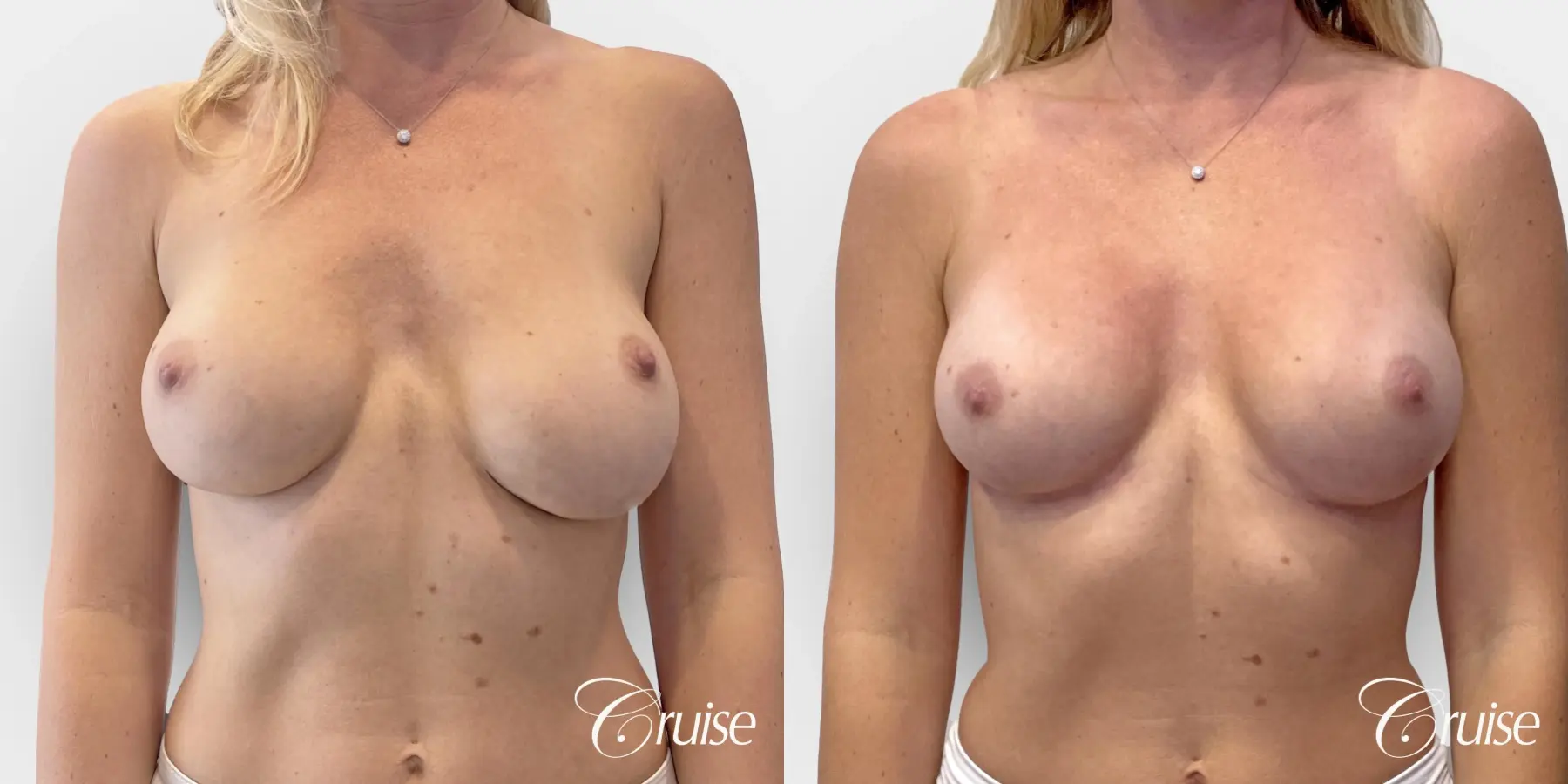 Breast Implant Revision - Before and After 1