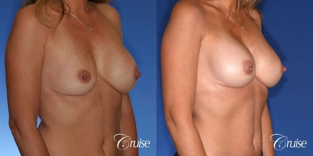 best revision on a saline breast implant rupture - Before and After 4