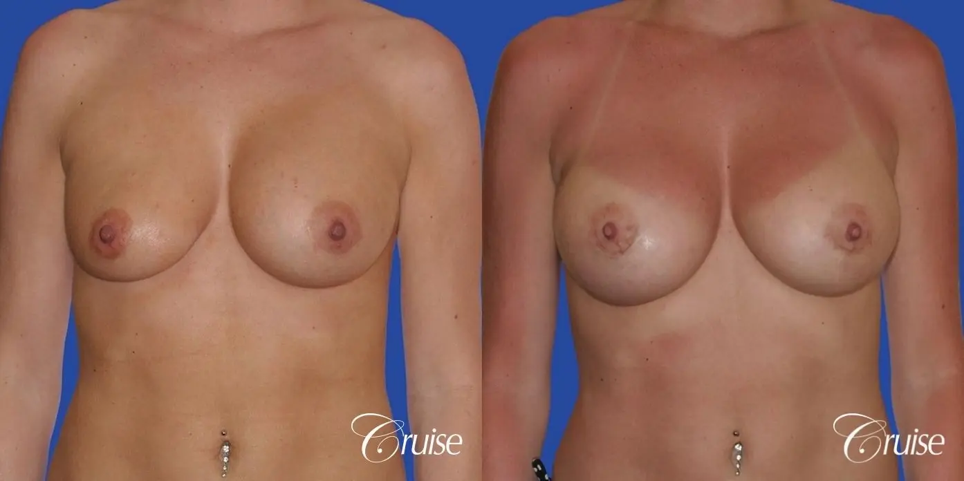 breast revision with silicone implant rupture - Before and After 1