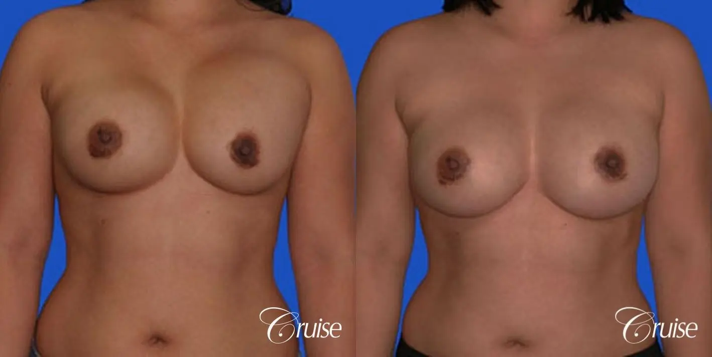 left breast capsular contracture before and after photos - Before and After 1
