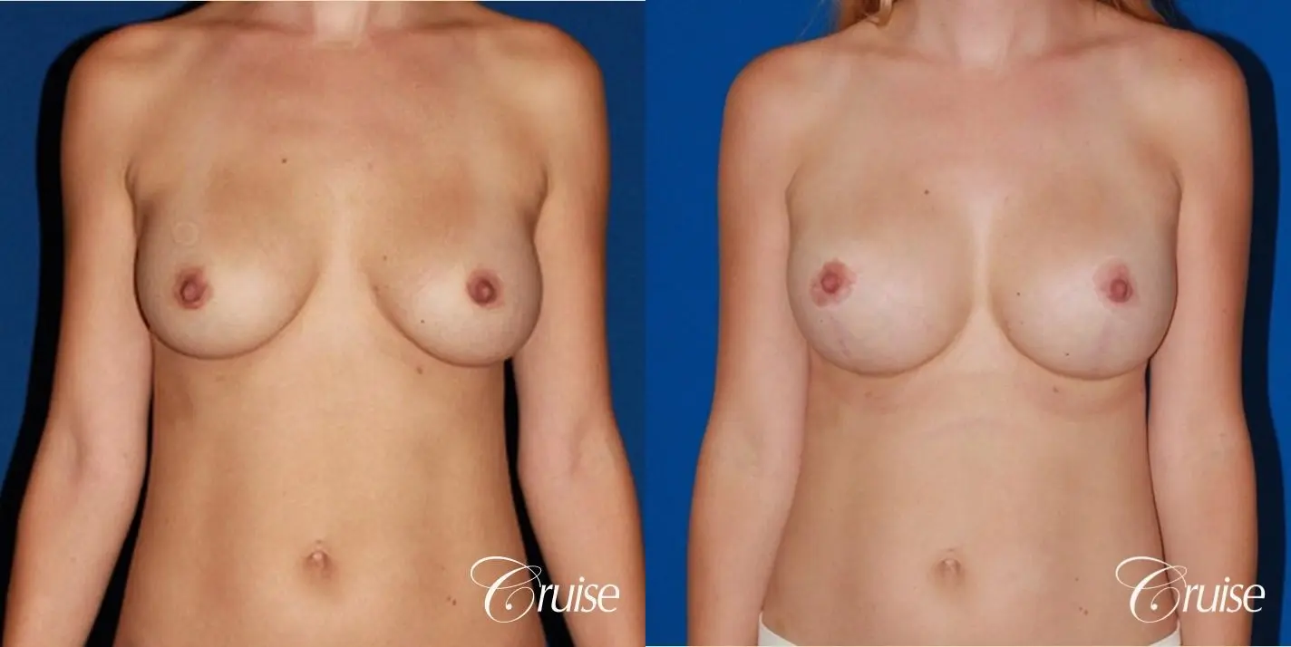 best breast revision for closer cleavage - Before and After 1