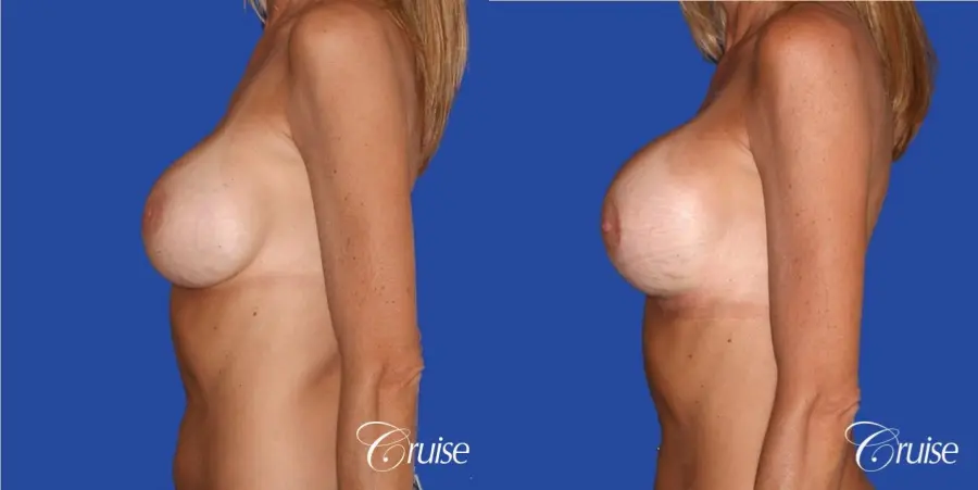 best breast revision for better cleavage and shape - Before and After 2