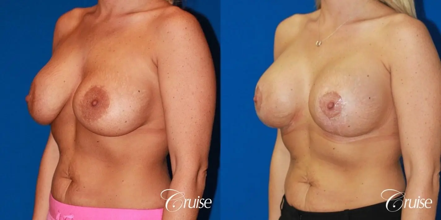 best breast revision to lift low implants - Before and After 3