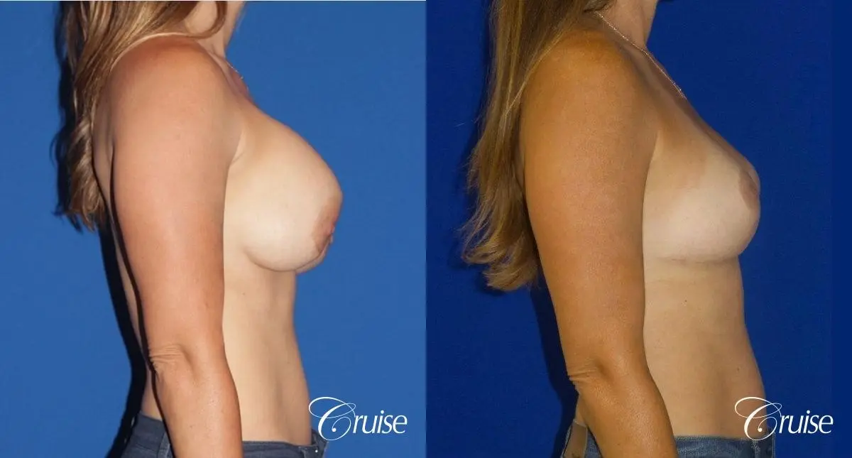 Breast Revision: Patient 2 - Before and After 3