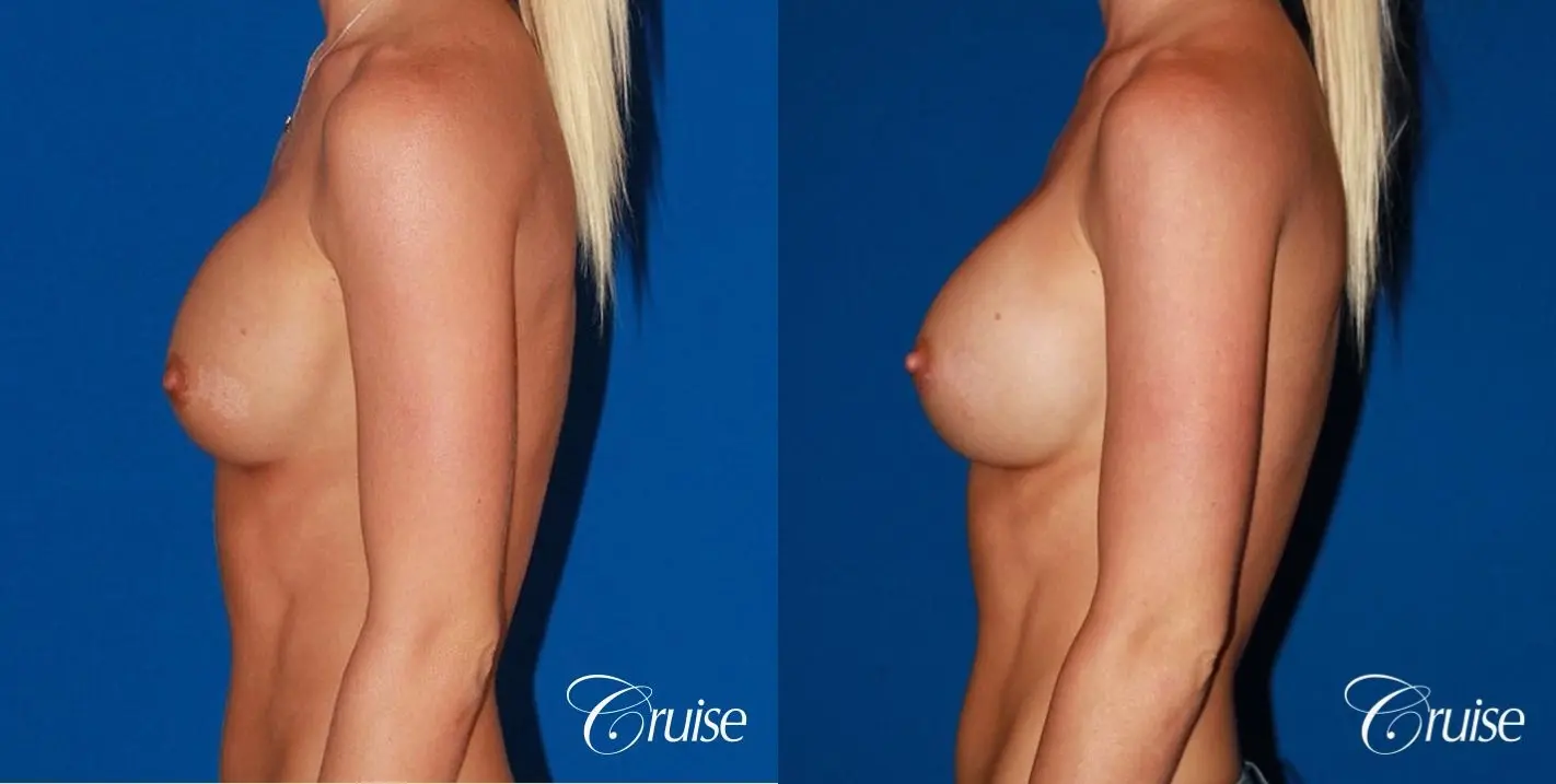 breast revision with best results for breast asymmetries - Before and After 2