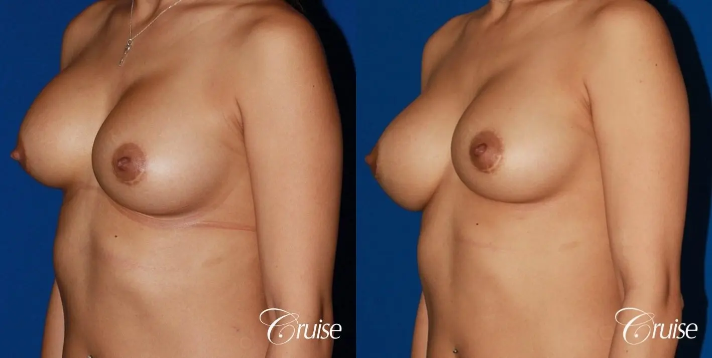 saline capsular contracture breast revision pictures - Before and After 2
