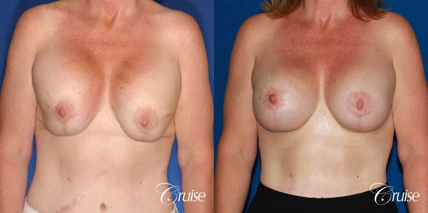 bilateral capsular contracture silicone - Before and After