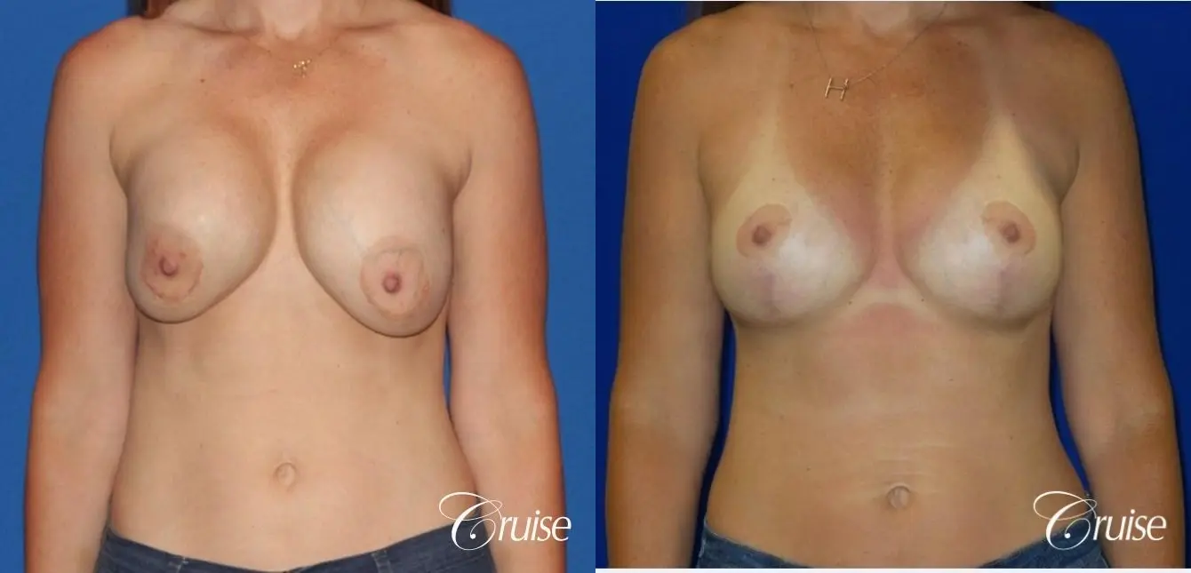 Breast Revision: Patient 2 - Before and After 1