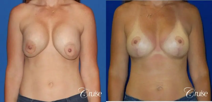 Breast Revision: Patient 2 - Before and After  