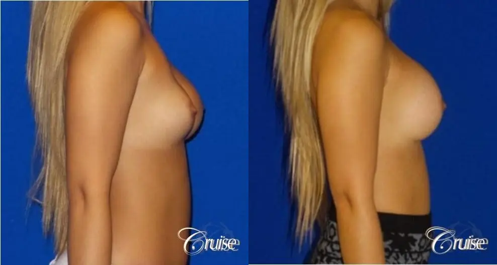 Breast Revision - Before and After 3