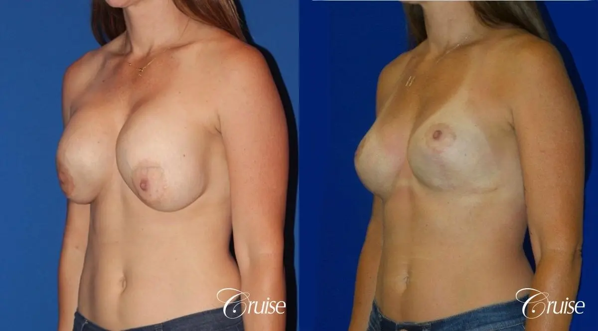 Breast Revision: Patient 2 - Before and After 2
