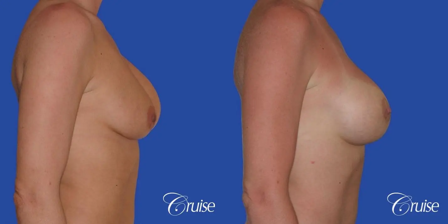 breast revision with silicone implant rupture - Before and After 3