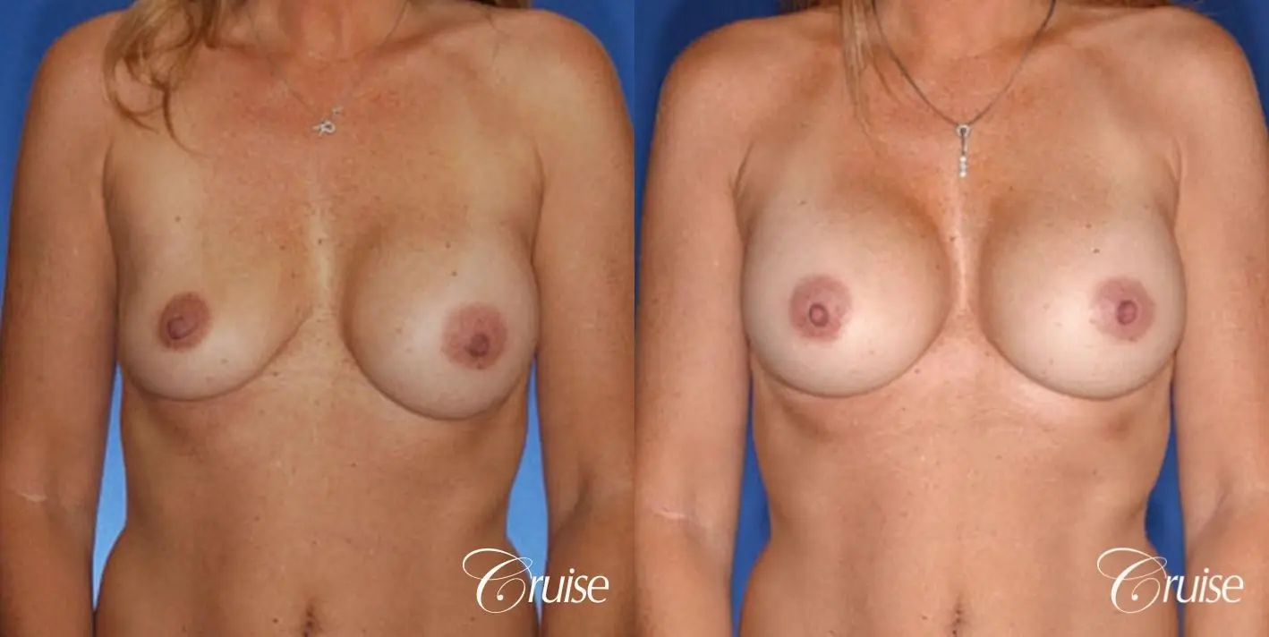 best revision on a saline breast implant rupture - Before and After 1