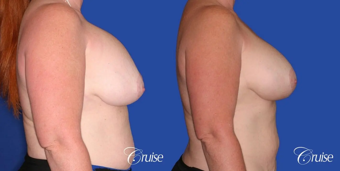 capsular contracture before and after pictures in Newport Beach - Before and After 3