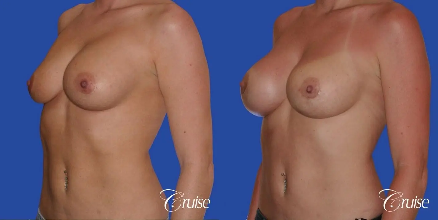breast revision with silicone implant rupture - Before and After 2