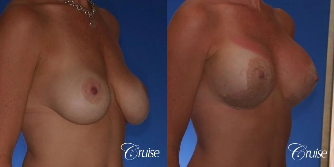 Best breast revision for low implants - Before and After 3