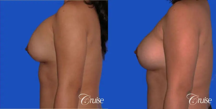 left breast capsular contracture before and after photos - Before and After 2