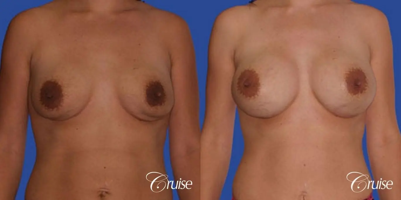 best breast revision correction of double bubble - Before and After 1