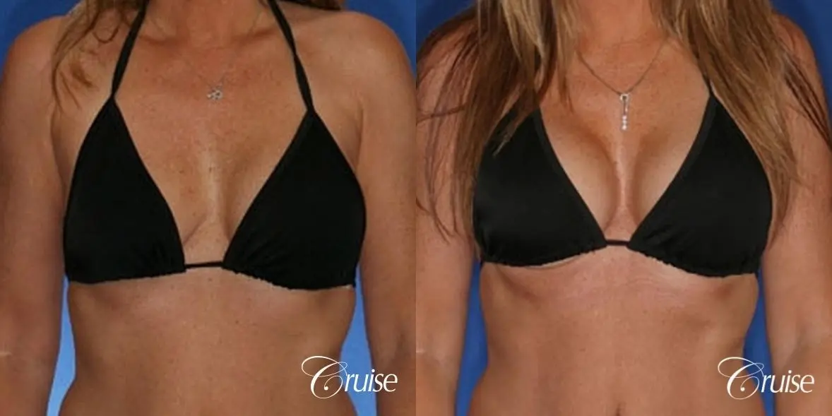 best revision on a saline breast implant rupture - Before and After 3