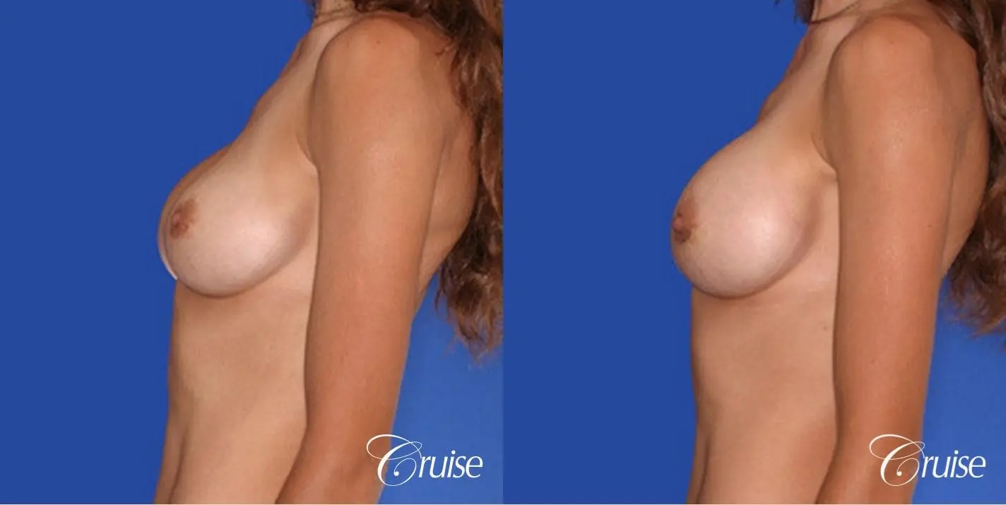 best pictures of breast implant rupture saline - Before and After 2